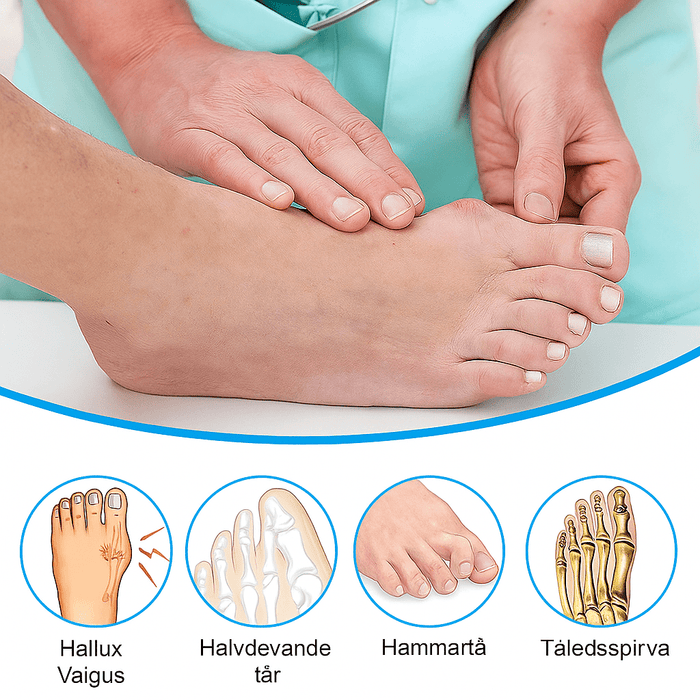 Kroppsbutiken Hallux valgus Oletustunnus Hallux Valgus - Isovarvosopeurakit