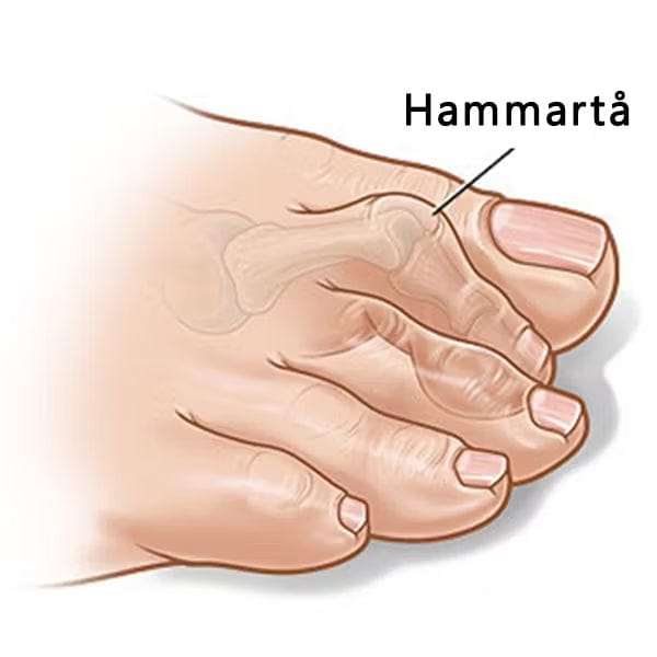 Kroppsbutiken Jalkatuki Oletusotsikko Lapaluun tukevä hammartå (2 kpl)