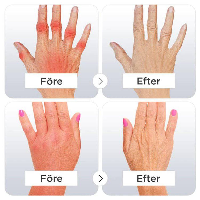 Kroppsbutiken Puristushanskat Puristuslaput nivelreumalle